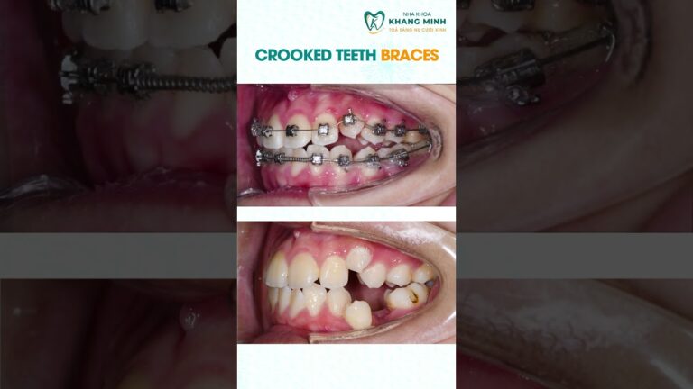 Crooked Teeth Braces #shorts #braces #dentistry #orthodontist #khangminhdental