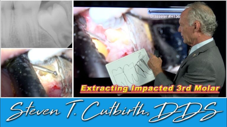 How to Extract an Impacted Third Molar – Dental Minute with Steven T. Cutbirth, DDS
