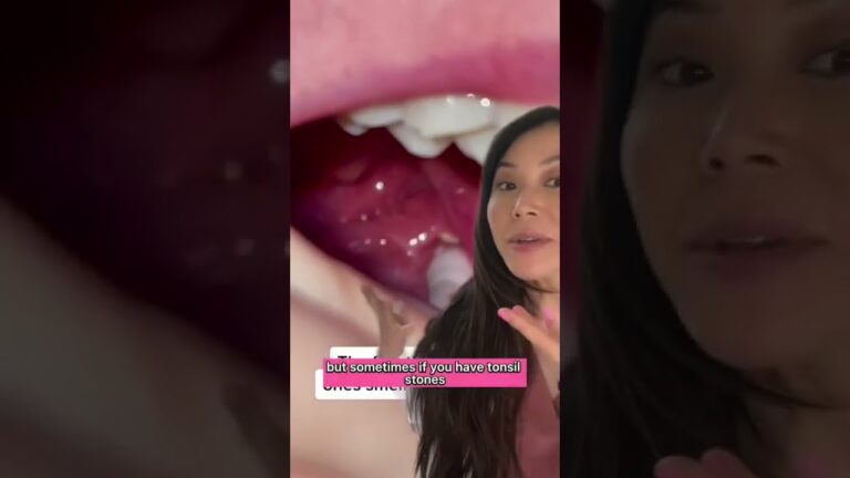 BAD BREATH from Tonsil Stones #badbreath #tonsilstones