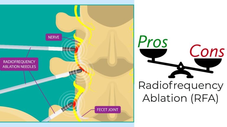Radiofrequency Ablation – Pros & Cons