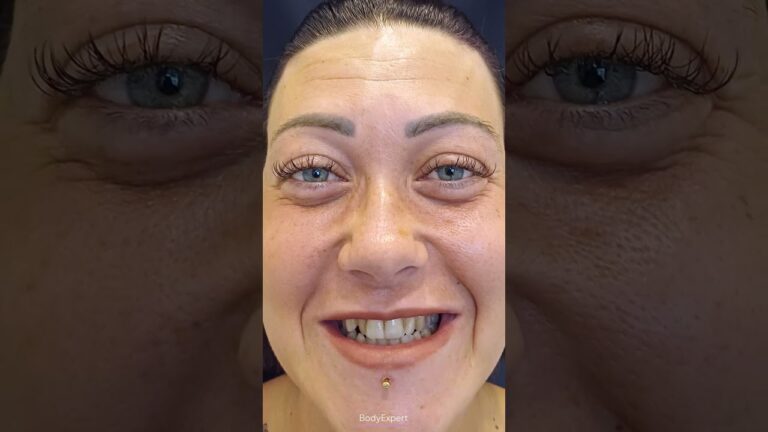 DENTIST IN TURKEY | 🦷 Stella's testimony: 20 Emax crowns | BODYEXPERT
