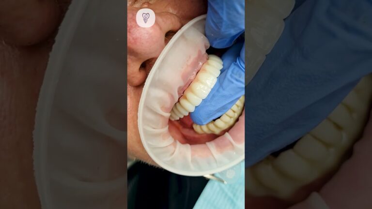 Ювелирная циркониевая балка для пациента. Имплантация зубов. #dentist