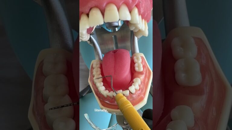 Use your Periodontal Probe for more than pocket depths. #dental #periodontics #dentalhygienist
