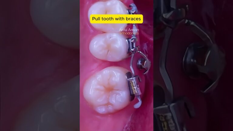 Closing gaps with braces #dentist #braces #orthodontist