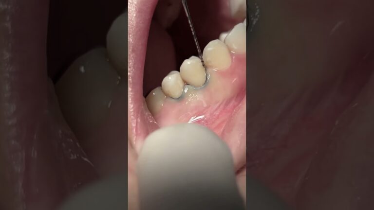 Class V composite restoration #dentist