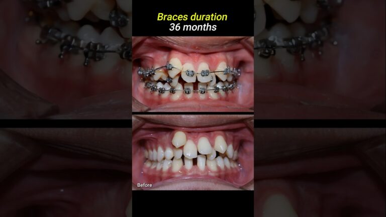 Braces for crowded teeth #braces #orthodontist #dentistry #dentist