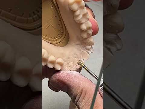 Making Beautiful Temporaries #short #shorts #shortvideo #dentist #dental #dentaltechnician
