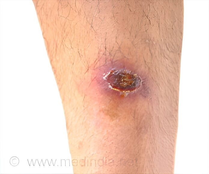 cancer-fighting-therapy-may-be-useful-in-wound-healing.jpg