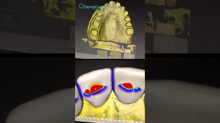 Lab Technology #dentalcentreturkey #shorts #smiledesign #turkeyteeth #dentistinantalya #dentistry